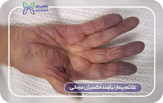 کبودی نوک انگشتان از علائم بیماران نیازمند اکسیژن درمانی